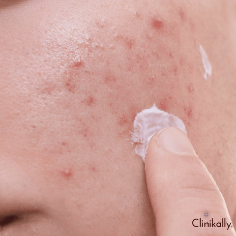 Myths vs. realities of pore size reduction
