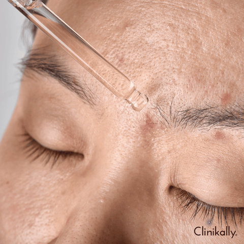 Glycolic Acid for Hyperpigmentation and Scarring: What You Need to Know