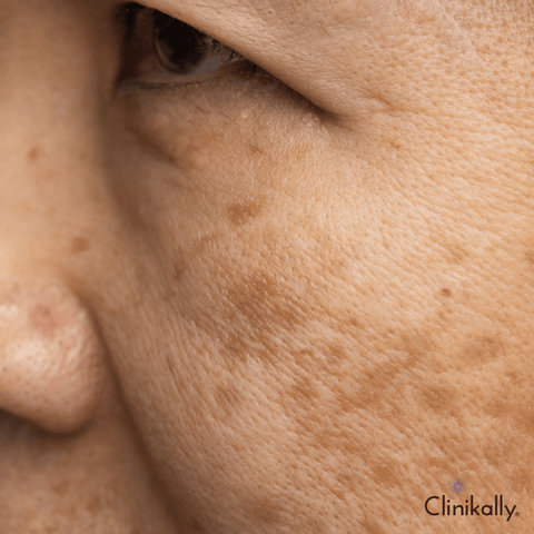 Melasma: How Azelaic Acid Can Help Even Out Your Skin Tone
