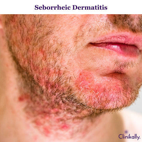 Seborrheic Dermatitis and Beard Dandruff