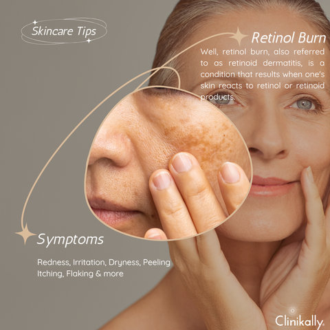This image shows an old age skin telling about what is retinol burn and what are the symptoms associated with it
