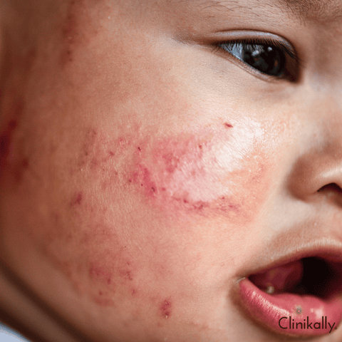 What age groups can get eczema?