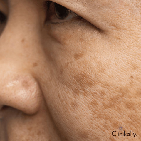 Ferulic acid for hyperpigmentation and fine lines
