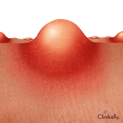 Symptoms of Fungal Acne
