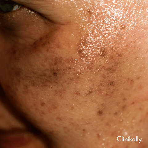 Expert tips to prevent pigmentation