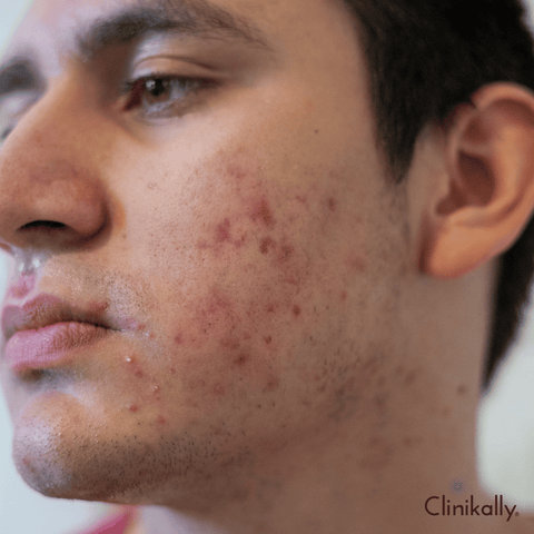 Types of Fungal Acne