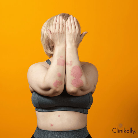 How to prevent an eczema flare-up