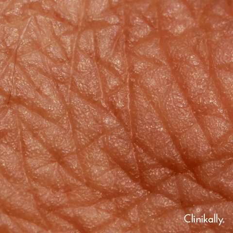 What is skin barrier?
