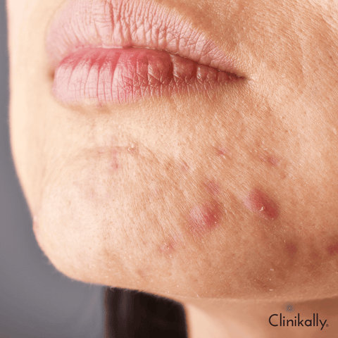 Whiteheads on chin