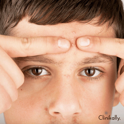 Whiteheads on forehead