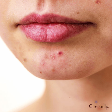 Pityrosporum Folliculitis