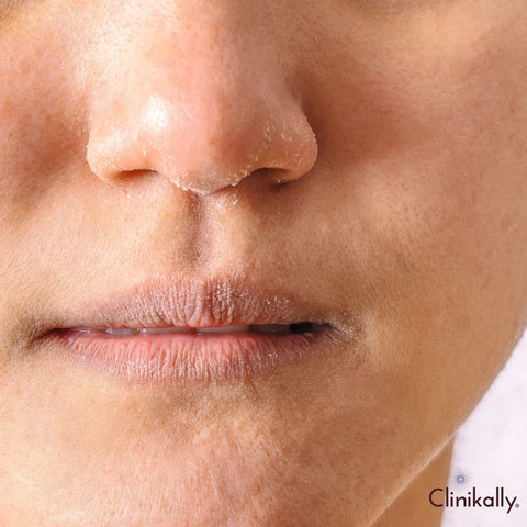 Causes of dry skin