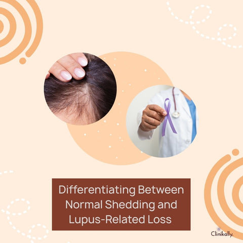 Differentiating Between Normal Shedding and Lupus-Related Loss