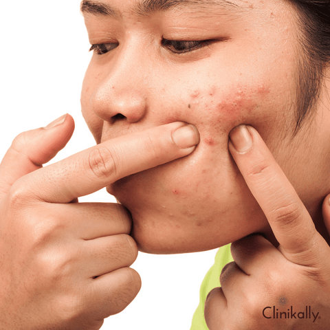Causes and Triggers of Fungal Acne