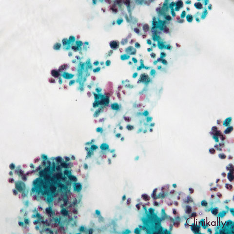 Yeast Overgrowth