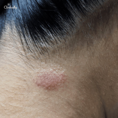 tinea infection on skin