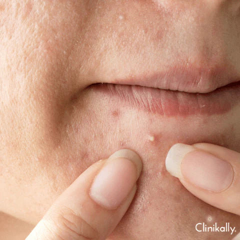 Weakens acne-causing bacteria