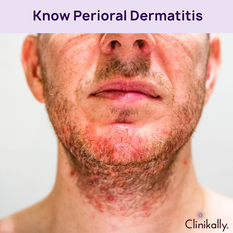 What is Perioral Dermatitis?