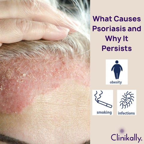 What Causes Psoriasis and Why It Persists