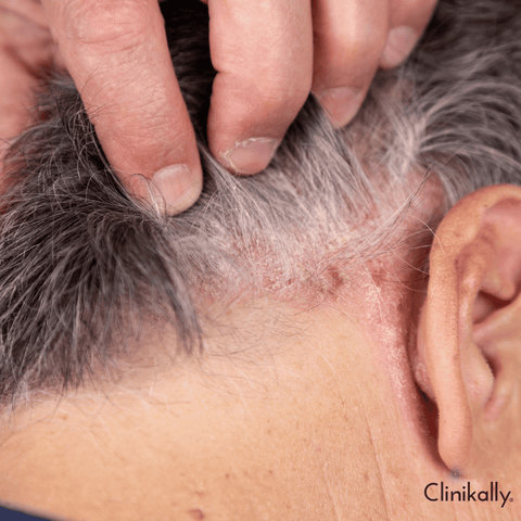 Environmental triggers of Alopecia Areata