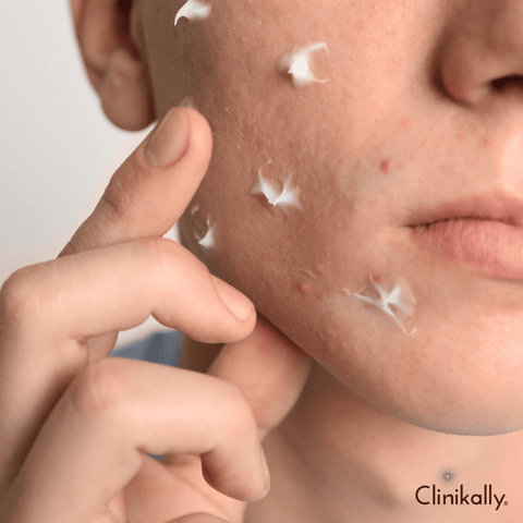 Best chicken pox scar removal creams