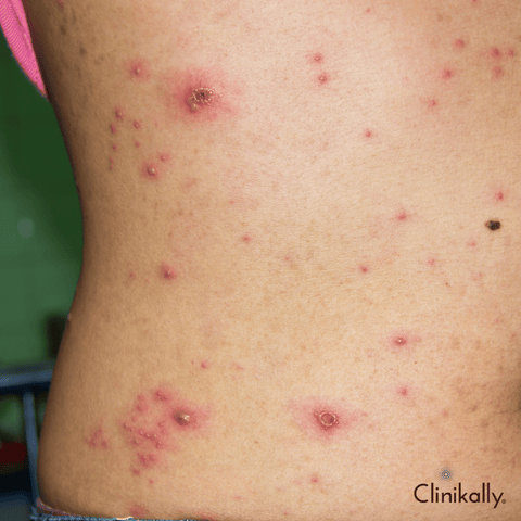 Understanding the Healing Process of Chicken Pox Scars