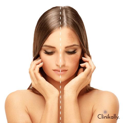 Most common types of pigmentation disorders