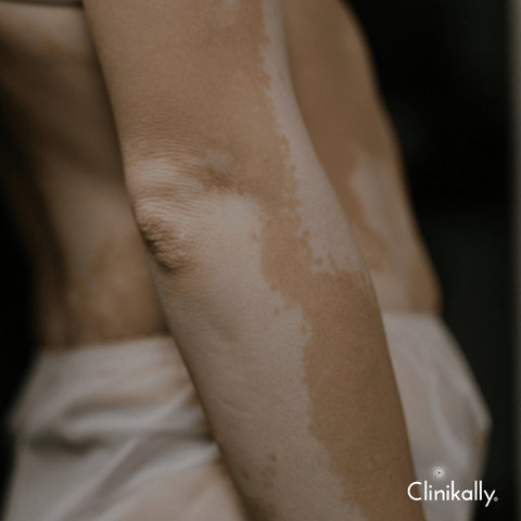 Causes of hypopigmentation