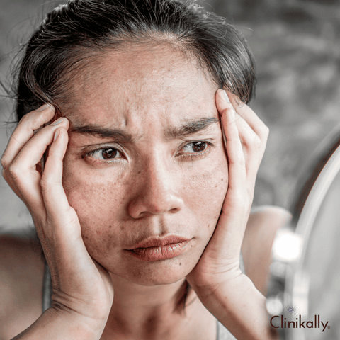 Causes of melasma
