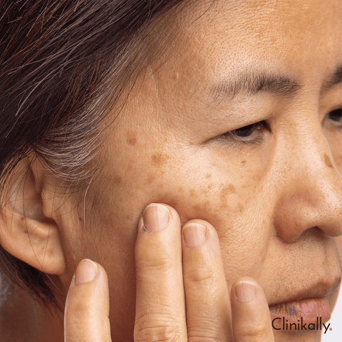 How to treat melasma