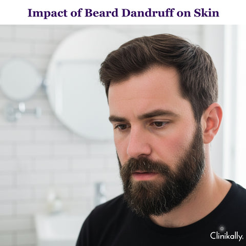 Impact of Beard Dandruff on Skin and Beard Health