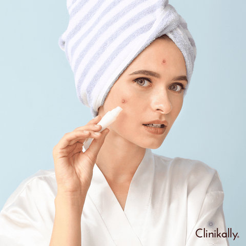 #5 Use an acne spot treatment cream for pimples