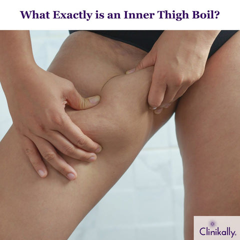 Know Basics: Causes and Symptoms of Inner Thigh Boils