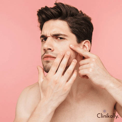 Prevention of Fungal Acne