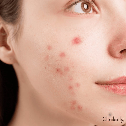 The link between hygiene and acne