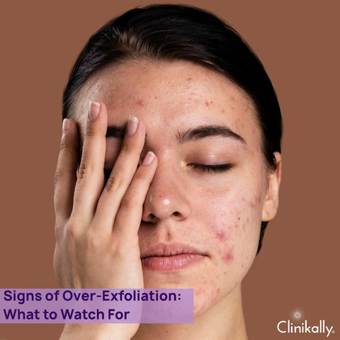 Signs of Over-Exfoliation: What to Watch For