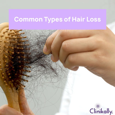 Common Types of Hair Loss