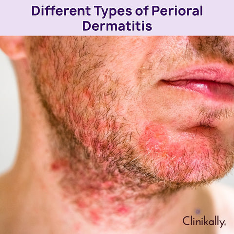 What are the types and variants of Perioral Dermatitis?