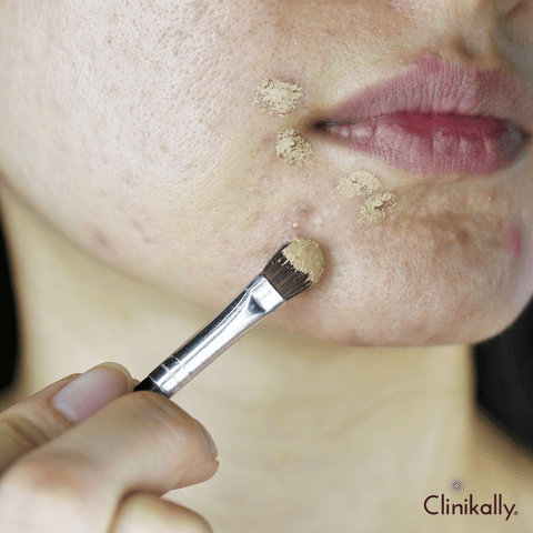 Mineral Makeup for Acne-Prone Skin