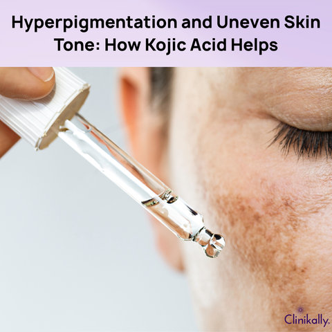 Hyperpigmentation and Uneven Skin Tone: How Kojic Acid Helps
