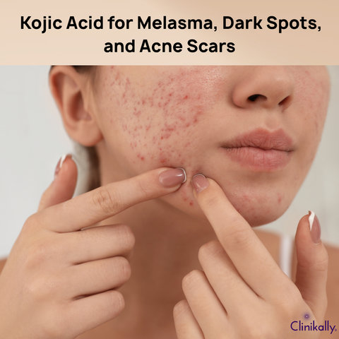 Kojic Acid for Melasma, Dark Spots, and Acne Scars