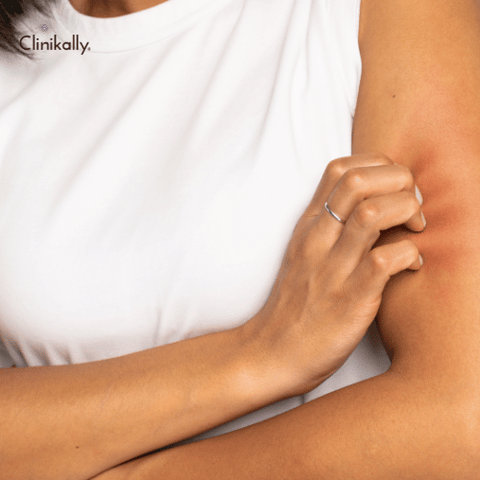 treat Ashy skin 