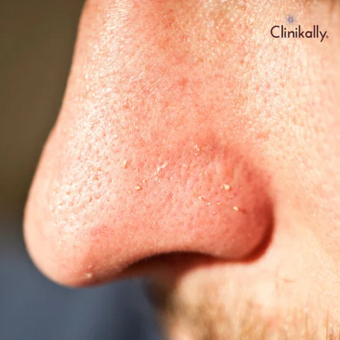 milia white bumps on face