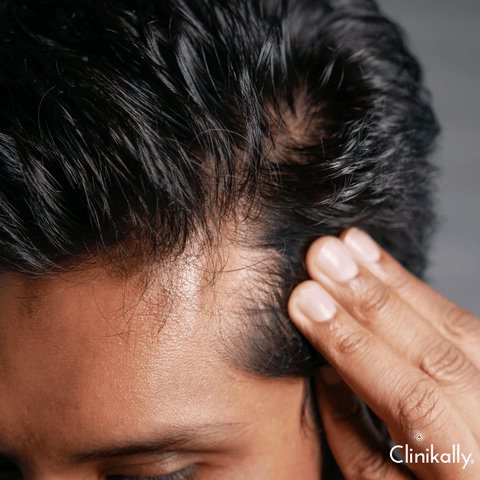 Quick facts about hair loss