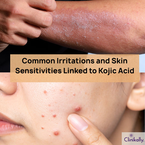 Common Irritations and Skin Sensitivities Linked to Kojic Acid