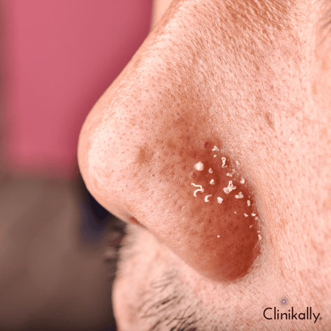 Mineral Makeup is Non-Comedogenic