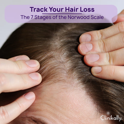 Stages of Male Pattern Baldness