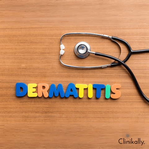 Treating Seborrheic Dermatitis