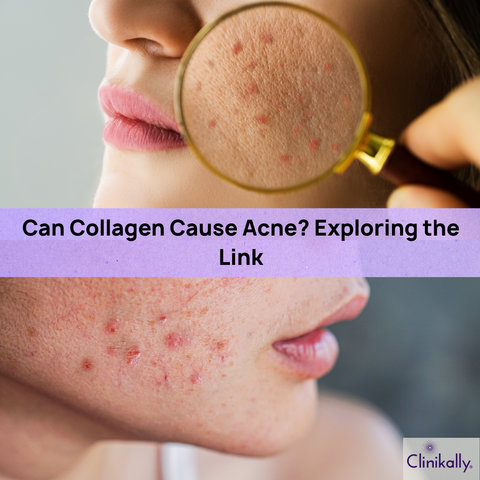 Can Collagen Cause Acne? Exploring the Link