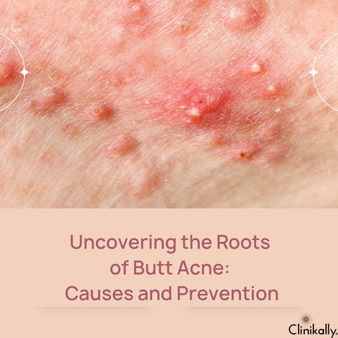 Uncovering the Roots of Butt Acne: Causes and Prevention